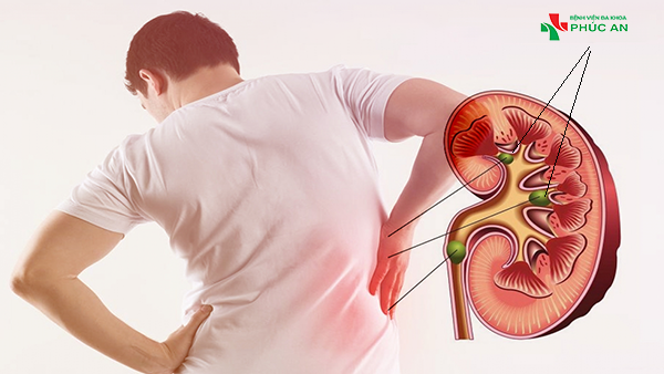 Bệnh nhân đau lưng do sỏi thận – Bệnh viện Đa khoa Phúc An