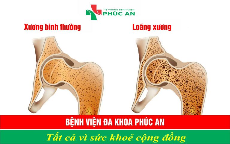 BỆNH LOÃNG XƯƠNG – NGUYÊN NHÂN, TRIỆU CHỨNG VÀ CÁCH PHÒNG NGỪA