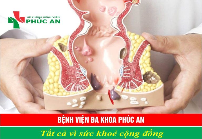 BỆNH TRĨ – NGUYÊN NHÂN VÀ CÁCH ĐIỀU TRỊ