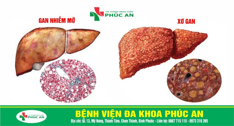 GAN NHIỄM MỠ – Nguyên nhân, Triệu chứng và Cách phòng ngừa