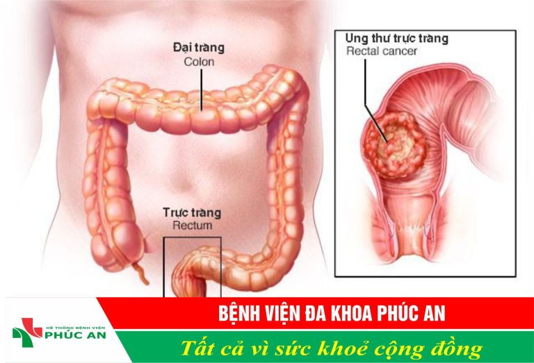 CÁC DẤU HIỆU CẢNH BÁO UNG THƯ ĐẠI TRÀNG