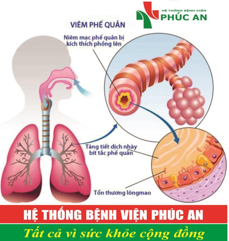 VIÊM PHẾ QUẢN PHỔI