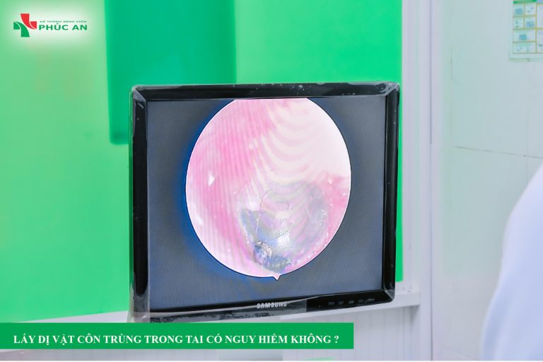 Lấy dị vật côn trùng trong tai có nguy hiểm không ?