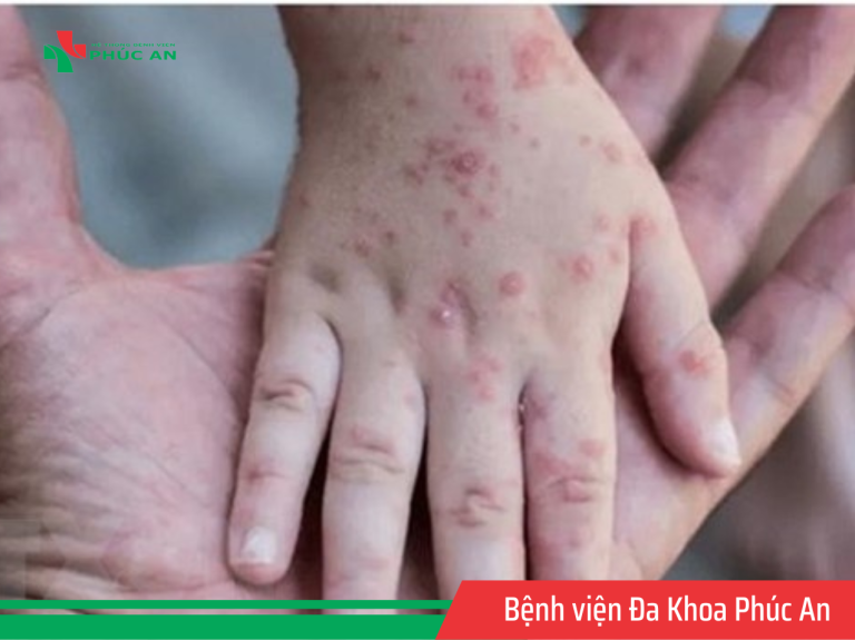 CDC Mỹ cảnh báo nguy cơ bệnh đậu mùa khỉ bùng phát trở lại