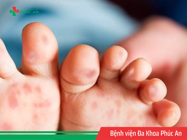 Bộ Y tế: Cần tăng cường công tác điều trị bệnh tay chân miệng