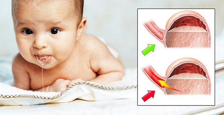DẤU HIỆU MỀM SỤN THANH QUẢN Ở TRẺ