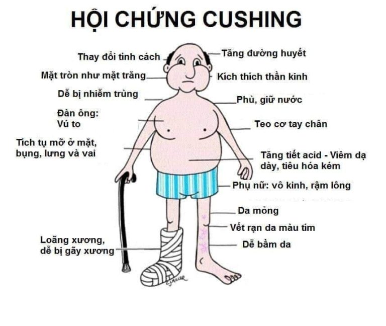 HỘI CHỨNG CUSHING