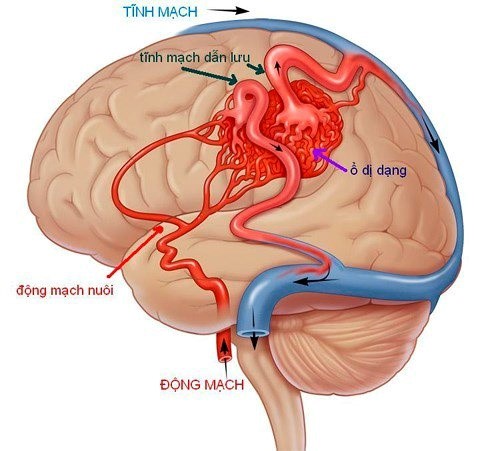 Xuất huyết mạch máu não