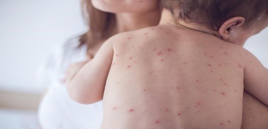 Những điều cần biết về xét nghiệm kháng thể thủy đậu
