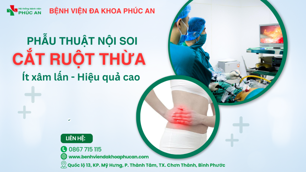 MỔ RUỘT THỪA BẰNG PHƯƠNG PHÁP NỘI SOI Ổ BỤNG: ÍT XÂM LẤN – HIỆU QUẢ CAO