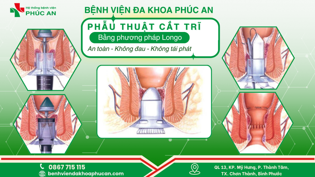 Phẫu Thuật Trĩ Bằng Phương Pháp Longo