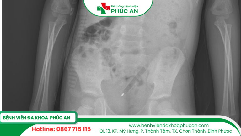 BVĐK Phúc An Cấp Cứu Thành Công Bé Trai 7 Tuổi Bị Bút Bi Đâm Sâu Vào Hậu Môn