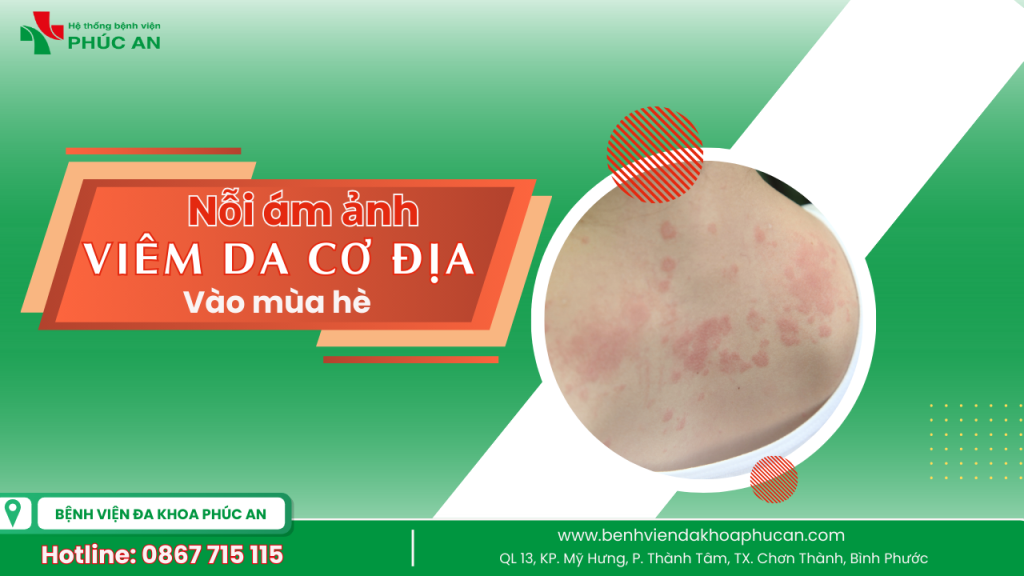 NỖI ÁM ẢNH MANG TÊN VIÊM DA CƠ ĐỊA MÙA HÈ