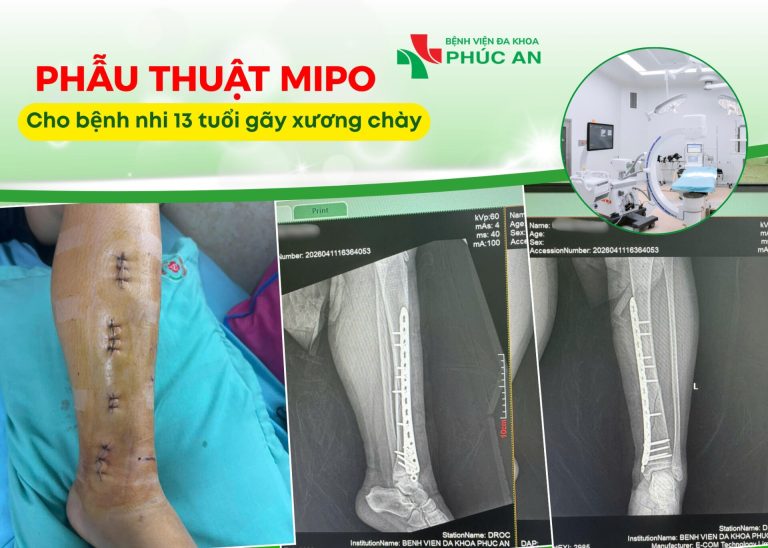 PHẪU THUẬT MIPO – PHƯƠNG PHÁP KẾT HỢP XƯƠNG ÍT XÂM LẤN CHO BỆNH NHI 13 TUỔI GÃY XƯƠNG CHÀY